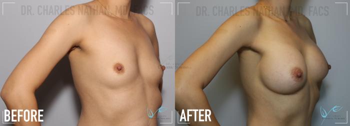 Before & After Mommy Makeover Case 133 Right Oblique- Breast Augmentation View in St. Louis, MO