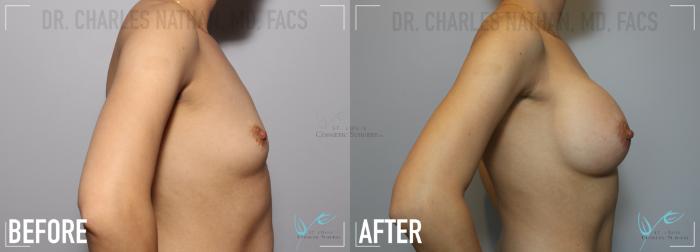 Before & After Tummy Tuck Case 133 Right Side- Breast Augmentation View in St. Louis, MO
