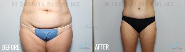 Before & After Breast Augmentation Case 151 Front- Abdominoplasty  View in St. Louis, MO
