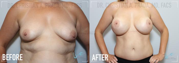 Before & After Liposuction Case 151 Front- Breast Augmentation  View in St. Louis, MO