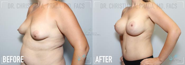 Before & After Breast Augmentation Case 151 Left Oblique View in St. Louis, MO