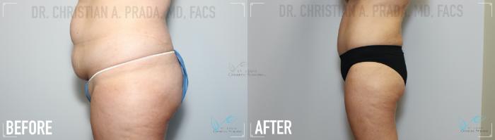 Before & After Tummy Tuck Case 151 Left Side- Abdominoplasty  View in St. Louis, MO