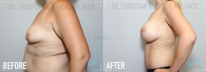 Before & After Liposuction Case 151 Left Side- Breast Augmentation  View in St. Louis, MO