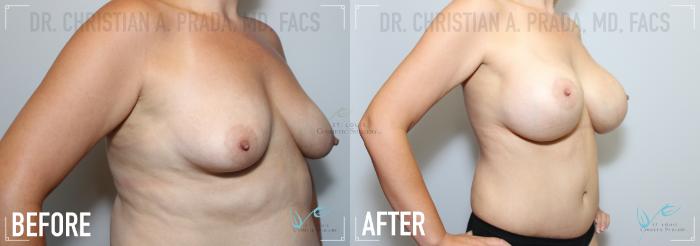 Before & After Breast Augmentation Case 151 Right Oblique View in St. Louis, MO