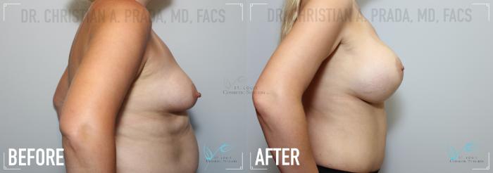 Before & After Liposuction Case 151 Right Side- Breast Augmentation  View in St. Louis, MO
