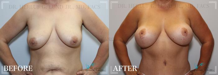 Before & After Tummy Tuck Case 185 Front- Breasts View in St. Louis, MO