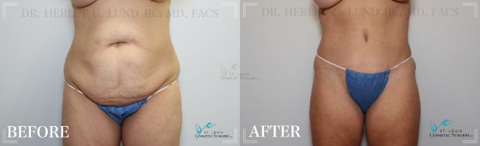 Before & After Tummy Tuck Case 185 Front View in St. Louis, MO