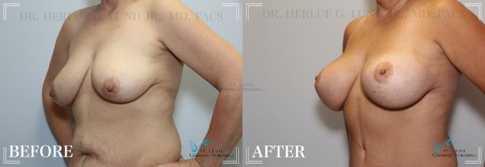 Before & After Mommy Makeover Case 185 Left Oblique- Breasts View in St. Louis, MO