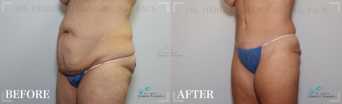 Before & After Tummy Tuck Case 185 Left Oblique View in St. Louis, MO
