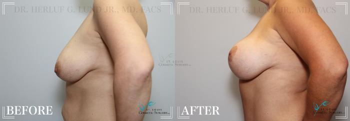 Before & After Tummy Tuck Case 185 Left Side- Breasts View in St. Louis, MO