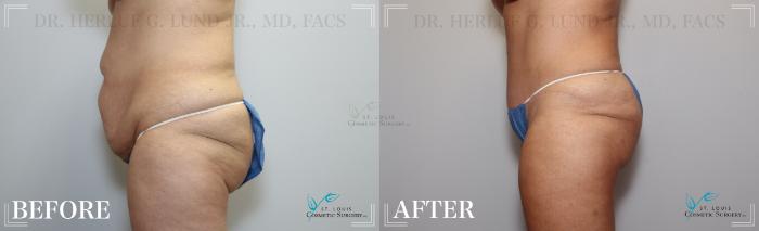 Before & After Tummy Tuck Case 185 Left Side View in St. Louis, MO