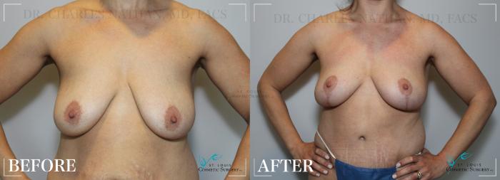 Before & After Breast Lift Case 188 Front View in St. Louis, MO