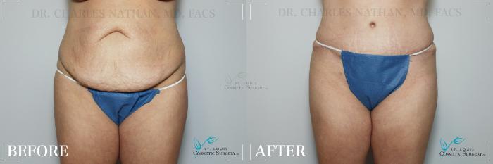 Before & After Breast Lift Case 188 Front-Abdominoplasty View in St. Louis, MO