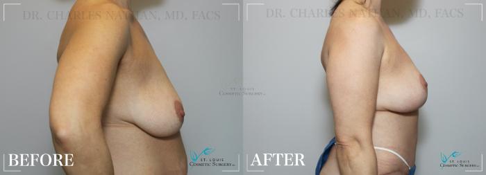 Before & After Breast Lift Case 188 Right Side View in St. Louis, MO