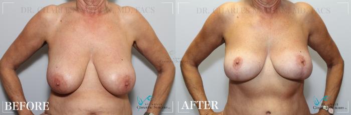 Before & After Breast Lift Case 189 FRONT- BREASTS View in St. Louis, MO
