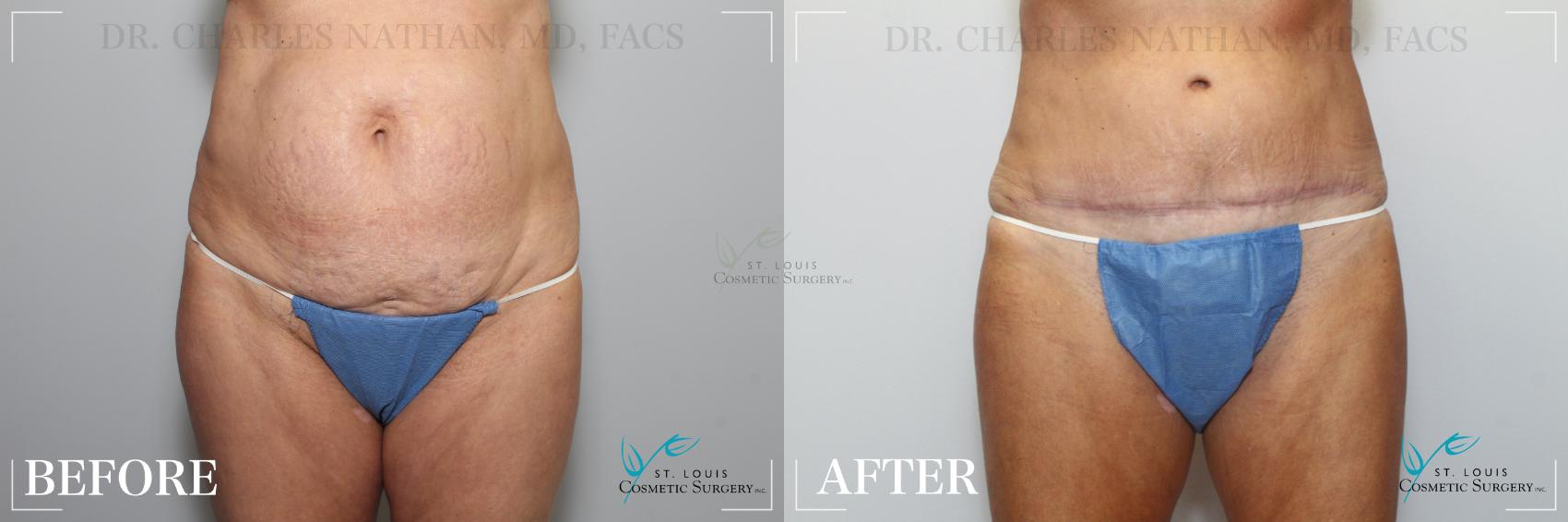 Before & After Tummy Tuck Case 189 Front View in St. Louis, MO