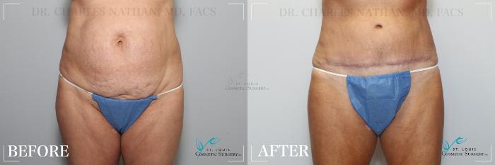 Before & After Tummy Tuck Case 189 Front View in St. Louis, MO