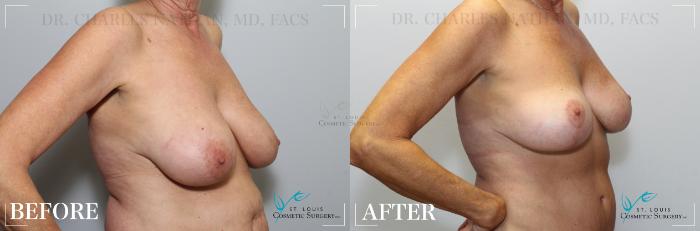 Before & After Mommy Makeover Case 189 OBLIQUE- BREASTS View in St. Louis, MO