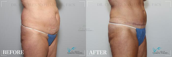 Before & After Breast Lift Case 189 Right Oblique View in St. Louis, MO