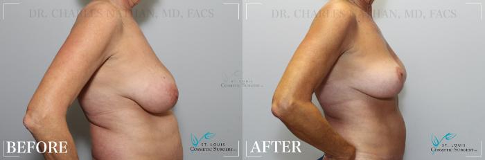 Before & After Breast Lift Case 189 RIGHT SIDE- BREASTS View in St. Louis, MO