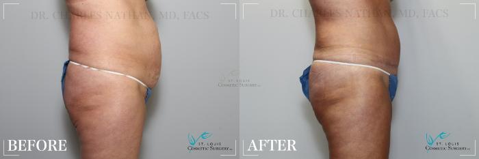 Before & After Breast Lift Case 189 Right Side View in St. Louis, MO