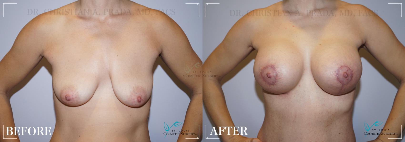 Before & After Mommy Makeover Case 215 FRONT- BREASTS View in St. Louis, MO