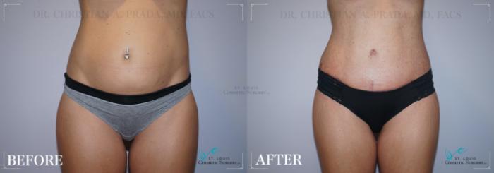 Before & After Tummy Tuck Case 215 FRONT-ABDOMINOPLASTY View in St. Louis, MO