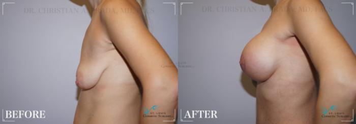 Before & After Tummy Tuck Case 215 SIDE- BREASTS View in St. Louis, MO