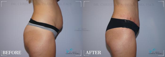 Before & After Mommy Makeover Case 215 SIDE-ABDOMINOPLASTY View in St. Louis, MO