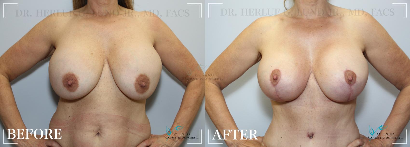 Before & After Tummy Tuck Case 220 FRONT- BREASTS View in St. Louis, MO