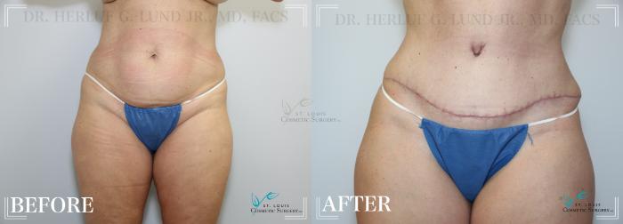 Before & After Tummy Tuck Case 220 Front View in St. Louis, MO