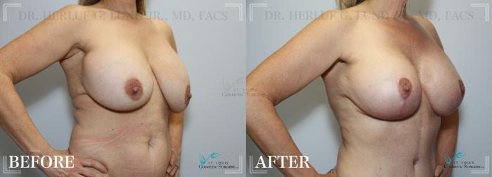 Before & After Breast Augmentation Case 220 OBLIQUE-BREASTS View in St. Louis, MO