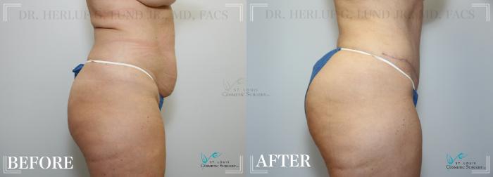 Before & After Tummy Tuck Case 220 Right Side View in St. Louis, MO