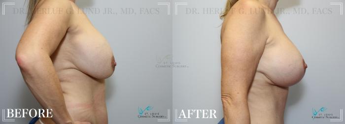 Before & After Breast Lift Case 220 SIDE-BREASTS View in St. Louis, MO