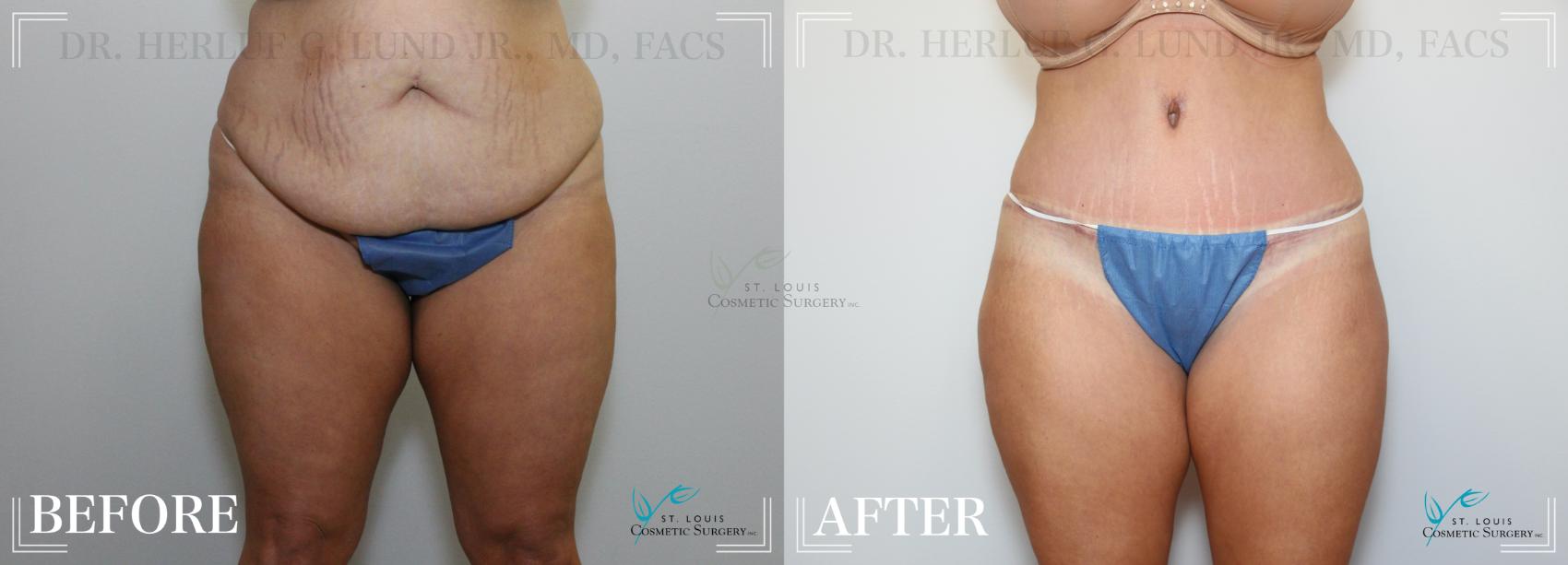 Before & After Breast Reduction Case 222 Front View in St. Louis, MO