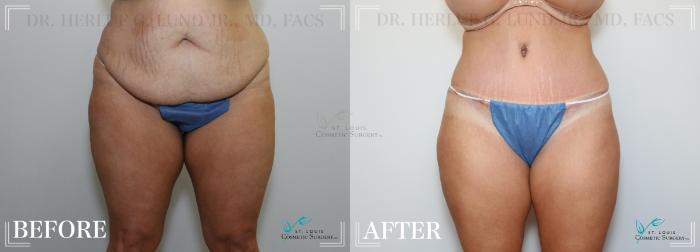 Before & After Breast Reduction Case 222 Front View in St. Louis, MO