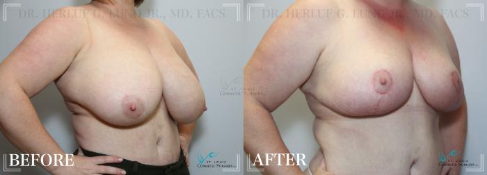 Before & After Breast Reduction Case 222 Oblique- Breasts View in St. Louis, MO