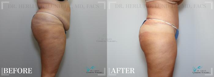 Before & After Tummy Tuck Case 222 Right Side View in St. Louis, MO