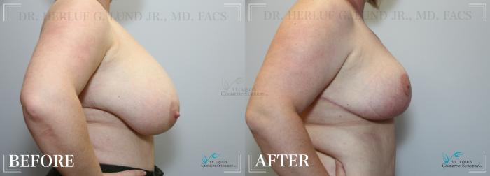 Before & After Tummy Tuck Case 222 Side-Breasts View in St. Louis, MO