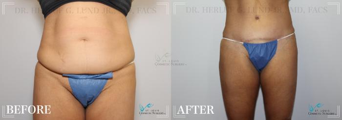 Before & After Mommy Makeover Case 233 Front- Abdominoplasty  View in St. Louis, MO