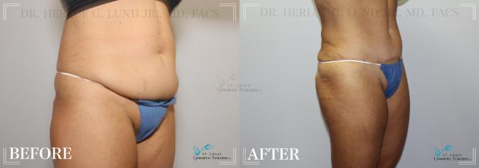 Before & After Mommy Makeover Case 233 Oblique- Abdominoplasty  View in St. Louis, MO