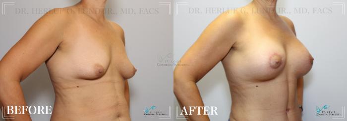 Before & After Mommy Makeover Case 233 Right Oblique View in St. Louis, MO