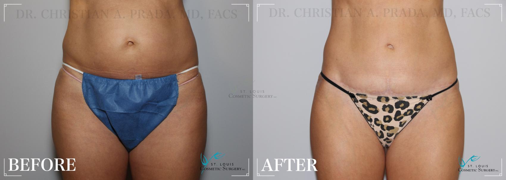 Before & After Breast Augmentation Case 242 Front View in St. Louis, MO