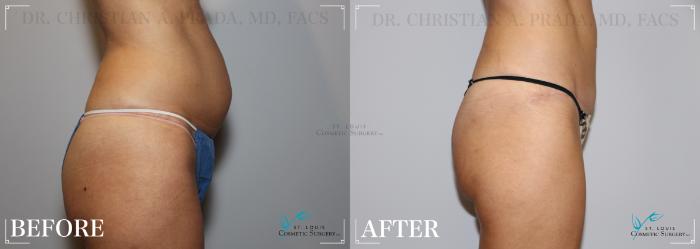 Before & After Breast Augmentation Case 242 Right Side View in St. Louis, MO