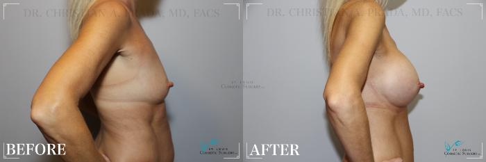 Before & After Breast Augmentation Case 242 Side- Breasts View in St. Louis, MO