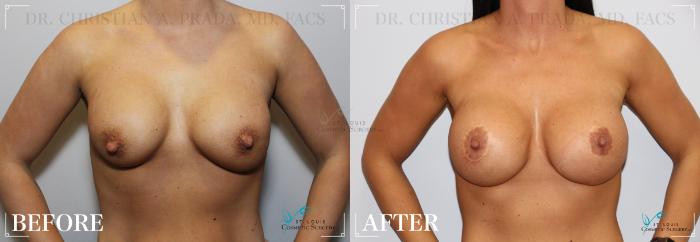 Before & After Tummy Tuck Case 256 FRONT- BREASTS View in St. Louis, MO