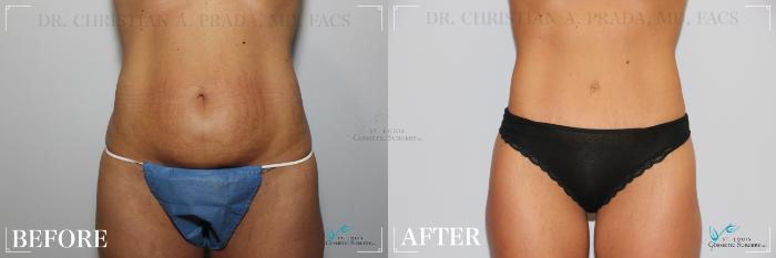 Before & After Tummy Tuck Case 256 Front View in St. Louis, MO