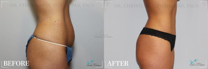 Before & After Breast Augmentation Case 256 Right Side View in St. Louis, MO