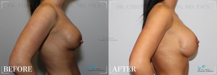 Before & After Mommy Makeover Case 256 SIDE-BREASTS View in St. Louis, MO