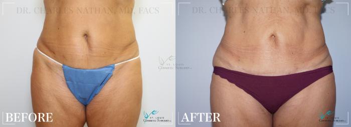Before & After Breast Lift Case 266 Front- Abdominoplasty View in St. Louis, MO